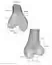 Fig. 02 - Total knee replacement implant based on normal anatomy and kinematics