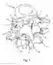Fig. 02 - FACET JOINT REPLACEMENT
