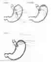 Fig. 07 - Magnetic satiety inducing system