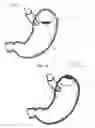 Fig. 08 - Magnetic satiety inducing system
