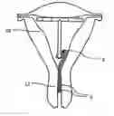 Fig. 01 - Intrauterine device with a restricted movement of a string knot