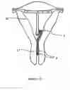 Fig. 06 - Intrauterine device with a restricted movement of a string knot