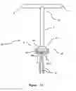 Fig. 07 - Intrauterine device with a restricted movement of a string knot