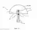 Fig. 09 - Intrauterine device with a restricted movement of a string knot