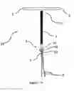 Fig. 22 - Intrauterine device with a restricted movement of a string knot