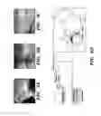 Fig. 09 - Elastic biopolymer and use as a tissue adhesive