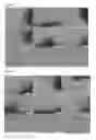 Fig. 17 - Composite Bone Implants