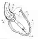 Fig. 01 - Support stent for transvalvular conduit