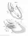 Fig. 04 - Support stent for transvalvular conduit