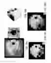 Fig. 22 - Automated assessment of glaucoma loss from optical coherence tomography