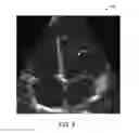 Fig. 05 - Automatic alignment of ultrasound volumes