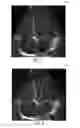 Fig. 06 - Automatic alignment of ultrasound volumes