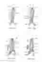 Fig. 06 - Methods and systems for aneurysm treatment using filling structures