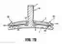 Fig. 07 - Occipital fixation assembly, system and method for attaching the same