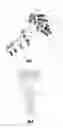 Fig. 02 - BONE FIXATION SYSTEM AND A PLATE THEREFOR