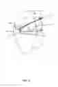 Fig. 06 - System and technique for accessing extra articular lesions or abnormalities or intra osseous lesions or bone marrow lesions