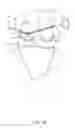 Fig. 18 - System and technique for accessing extra articular lesions or abnormalities or intra osseous lesions or bone marrow lesions