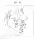 Fig. 11 - ORTHODONTIC TREATMENT METHOD USING AESTHETIC GUIDE LINE