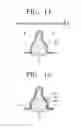 Fig. 06 - Clear aligner set and orthodontic treatment method considering resilience of human body