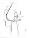 Fig. 06 - Heart valve treatment device and method