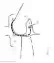Fig. 07 - Heart valve treatment device and method