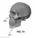 Fig. 09 - Bone implants for correcting bone defects