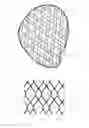 Fig. 35 - Bone implants for correcting bone defects