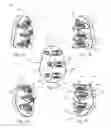 Fig. 02 - GLENOID ARTHROPLASTY