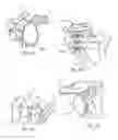 Fig. 06 - GLENOID ARTHROPLASTY