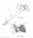 Fig. 30 - GLENOID ARTHROPLASTY