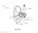 Fig. 35 - GLENOID ARTHROPLASTY
