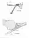 Fig. 63 - GLENOID ARTHROPLASTY