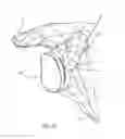 Fig. 64 - GLENOID ARTHROPLASTY