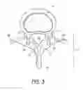 Fig. 04 - SYSTEM AND METHOD FOR PROTECTING NEUROVASCULAR STRUCTURES