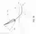 Fig. 10 - Cryogenic enhancement of joint function, alleviation of joint stiffness and/or alleviation of pain associated with osteoarthritis
