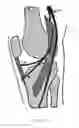 Fig. 19 - Cryogenic enhancement of joint function, alleviation of joint stiffness and/or alleviation of pain associated with osteoarthritis