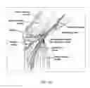 Fig. 20 - Cryogenic enhancement of joint function, alleviation of joint stiffness and/or alleviation of pain associated with osteoarthritis