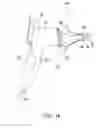 Fig. 02 - EARDRUM INCISION DEVICE