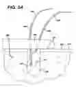 Fig. 06 - High strength suture with absorbable core and suture anchor combination