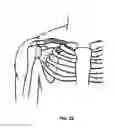 Fig. 22 - Method and apparatus for treating bone fractures, and/or for fortifying and/or augmenting bone, including the provision and use of composite implants, and novel composite structures which may be used for medical and non-medical applications