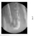 Fig. 09 - COATINGS CONTAINING MULTIPLE DRUGS