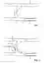 Fig. 02 - Device for prevention of shunt stenosis