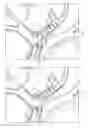 Fig. 05 - ANCHORING GUIDEWIRE