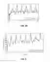 Fig. 05 - Methods and systems for lowering blood pressure through reduction of ventricle filling