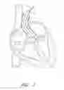 Fig. 02 - Suturing devices and methods for suturing an anatomic valve