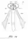 Fig. 17 - Suturing devices and methods for suturing an anatomic valve