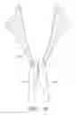 Fig. 55 - Suturing devices and methods for suturing an anatomic valve