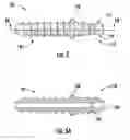 Fig. 04 - Bone fixation implant and means of fixation