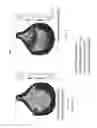 Fig. 09 - Polymeric heart valve