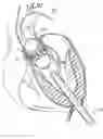 Fig. 01 - Transapical method of supplanting an implanted prosthetic heart valve
